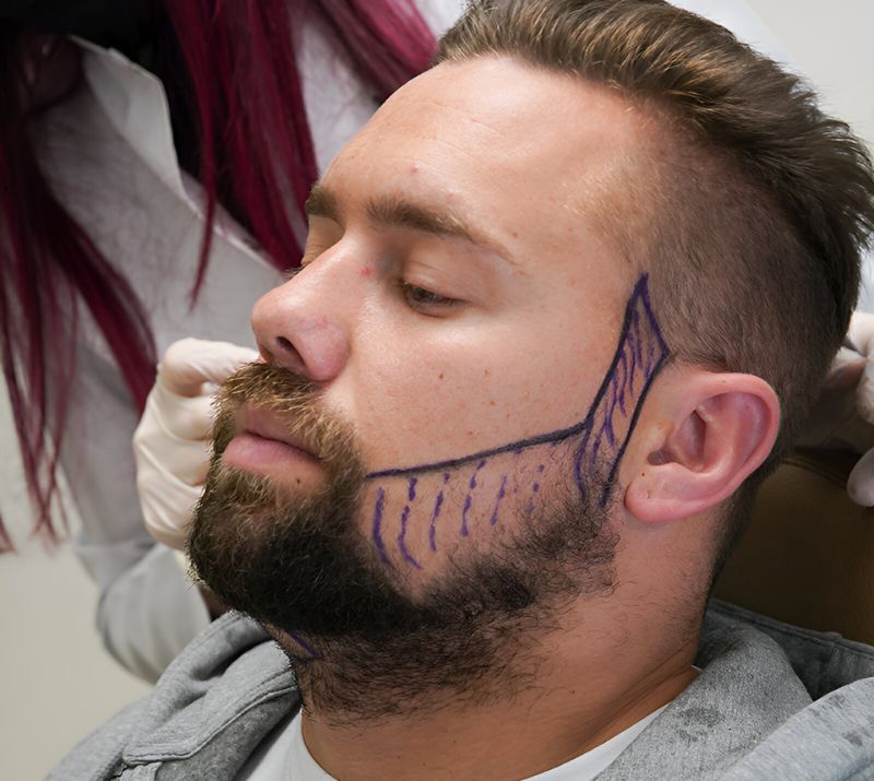 Airdrie Beard Transplant