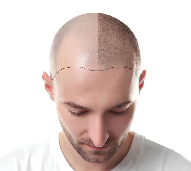 Ardrie Hair Transplants – Regain Your Confidence