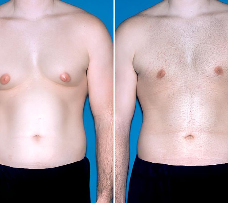 Male Breast Reduction In Lethbridge