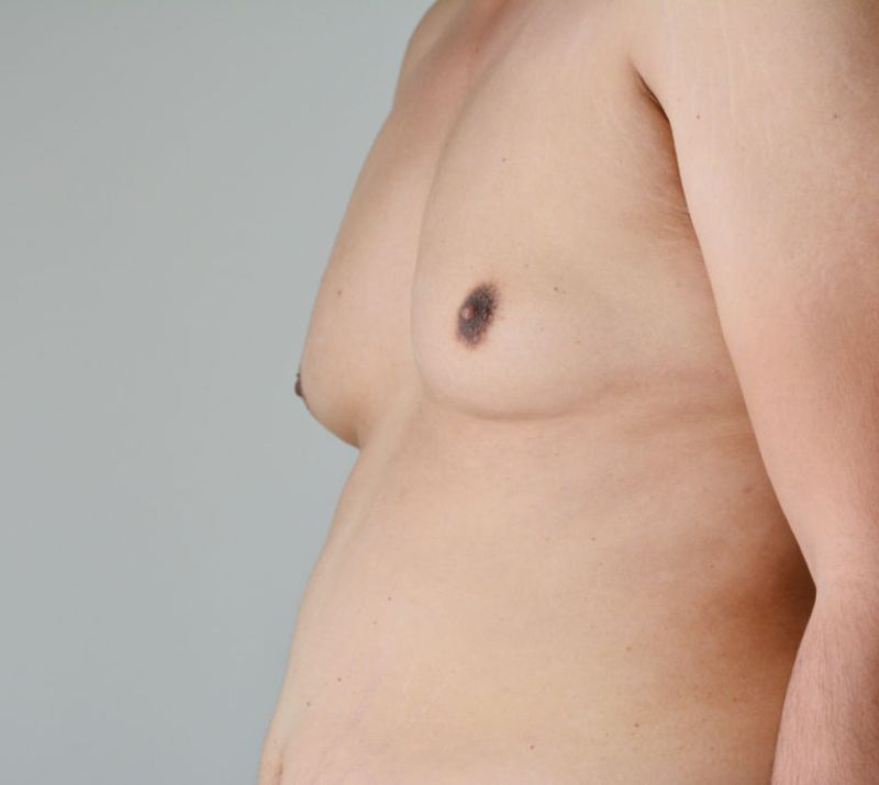 Male Breast Reduction with CoolSculpting in Wood Buffalo