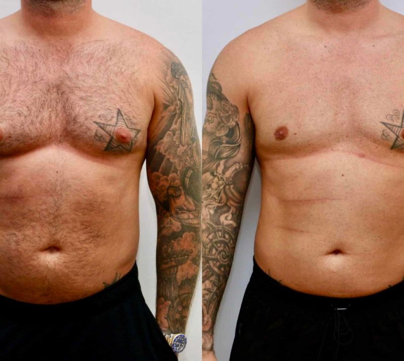 Red Deer Male Breast Reduction
