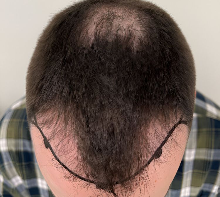 St. Albert Hair Transplant Services – Regain Your Confidence