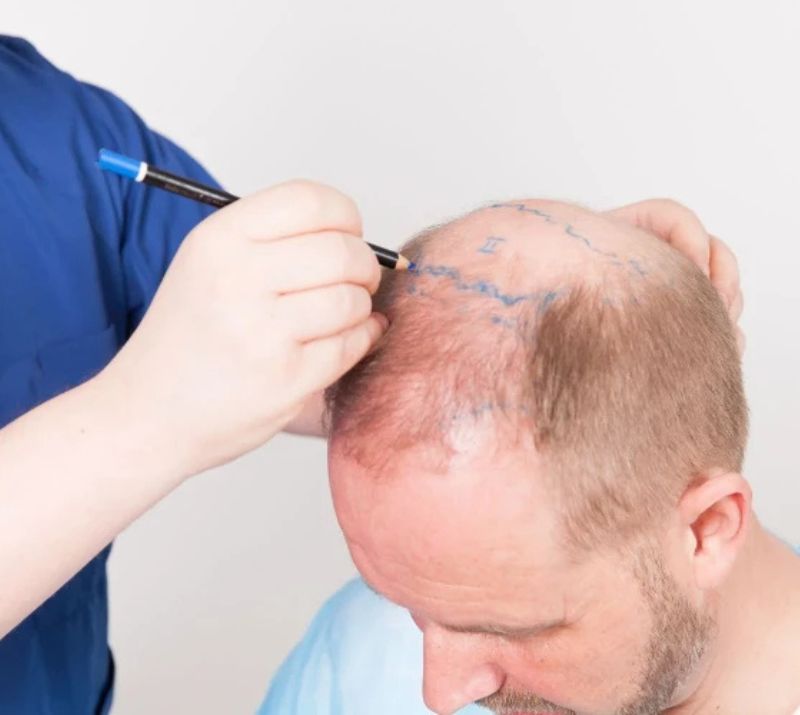 Strathcona County Hair Transplant For Men