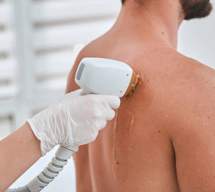 Strathcona County Laser Hair Removal For Men