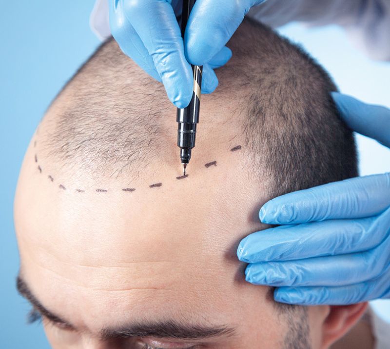 Hair Transplant And Restoration Services in Wood Buffalo