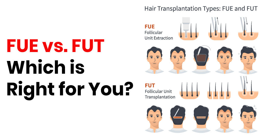 Hair Transplant Techniques: FUE vs. FUT – Which is Right for You?