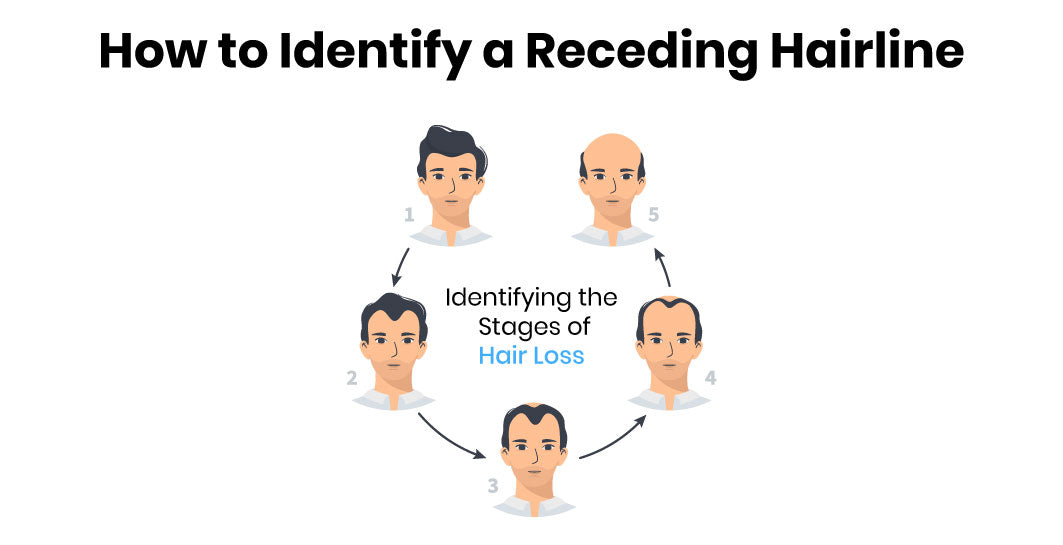 How to Identify a Receding Hairline