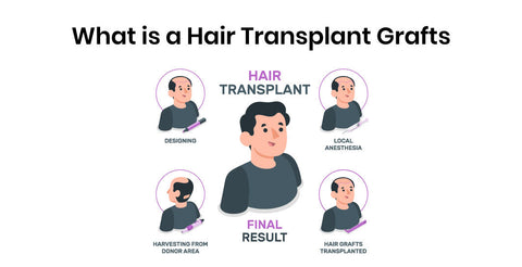 What is a Hair Transplant Graft: What They Are & How They Work