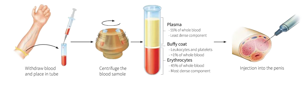 P Shot Procedure - Edmonton Men's Health