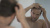 Hair Transplants - Edmonton Men's Health